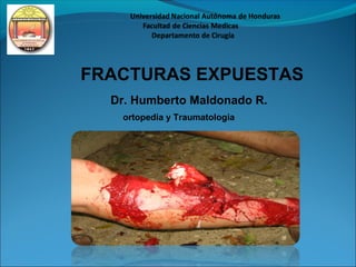 FRACTURAS EXPUESTAS
Dr. Humberto Maldonado R.
ortopedia y Traumatología

 