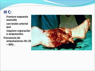 III C:
Fractura expuesta
asociada
con lesión arterial
que
requiere reparación
o amputación.
Frecuencia de
amputaciones IIIc 25
– 90% .

 