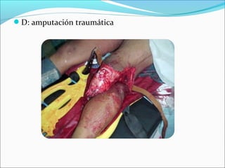 D: amputación traumática

 