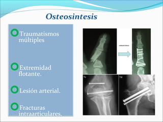 Osteosintesis
Traumatismos
múltiples

Extremidad
flotante.

Lesión arterial.
Fracturas
intraarticulares.

 