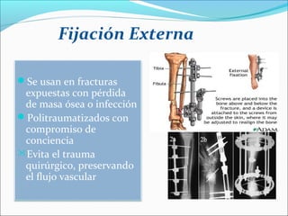 Fijación Externa
Se usan en fracturas

expuestas con pérdida
de masa ósea o infección
Politraumatizados con
compromiso de
conciencia
Evita el trauma
quirúrgico, preservando
el flujo vascular

 