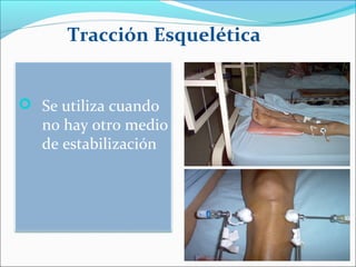 Tracción Esquelética

 Se utiliza cuando

no hay otro medio
de estabilización

 