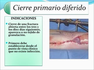 INDICACIONES
Cierre de una fractura

abierta entre los tres y
los diez días siguientes,
aparezca o no tejido de
granulación.

Primero debe

establecerse desde el
punto de vista clínico
que no existe infección.

 
