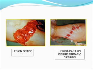 LESION GRADO
II

HERIDA PARA UN
CIERRE PRIMARIO
DIFERIDO

 