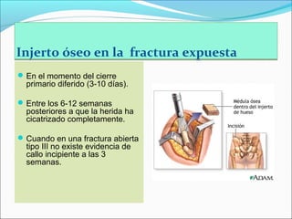 Injerto óseo en la fractura expuesta
 En el momento del cierre

primario diferido (3-10 días).

 Entre los 6-12 semanas

posteriores a que la herida ha
cicatrizado completamente.

 Cuando en una fractura abierta

tipo III no existe evidencia de
callo incipiente a las 3
semanas.

 