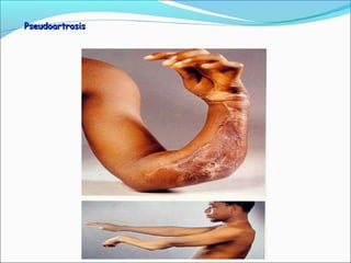 Pseudoartrosis

 