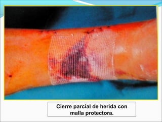 Cierre parcial de herida con
malla protectora.

 
