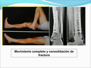 Movimiento completo y consolidación de
fractura

 