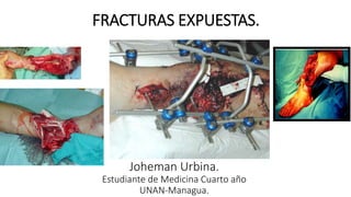 FRACTURAS EXPUESTAS. 
Joheman Urbina. 
Estudiante de Medicina Cuarto año 
UNAN-Managua. 
 