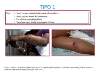 TIPO 1
• Duparc J, Huten D. Classification des fractures ouvertes. In: Conférence d’enseignement de la SOFCOT. Traitement des fractures récentes de
jambe. Paris: Expansion Scientifique Française; 2010. p. 62-72
 