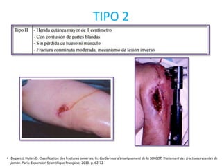 TIPO 2
• Duparc J, Huten D. Classification des fractures ouvertes. In: Conférence d’enseignement de la SOFCOT. Traitement des fractures récentes de
jambe. Paris: Expansion Scientifique Française; 2010. p. 62-72
 