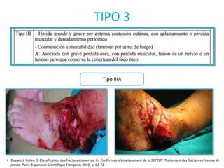 Tipo IIIA
TIPO 3
• Duparc J, Huten D. Classification des fractures ouvertes. In: Conférence d’enseignement de la SOFCOT. Traitement des fractures récentes de
jambe. Paris: Expansion Scientifique Française; 2010. p. 62-72
 