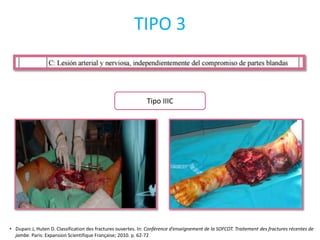 Tipo IIIC
TIPO 3
• Duparc J, Huten D. Classification des fractures ouvertes. In: Conférence d’enseignement de la SOFCOT. Traitement des fractures récentes de
jambe. Paris: Expansion Scientifique Française; 2010. p. 62-72
 