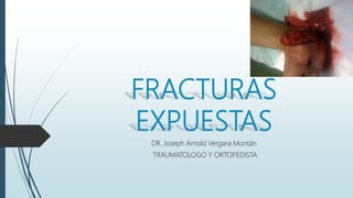FRACTURAS
EXPUESTAS
DR. Joseph Arnold Vergara Montán
TRAUMATOLOGO Y ORTOPEDISTA
 
