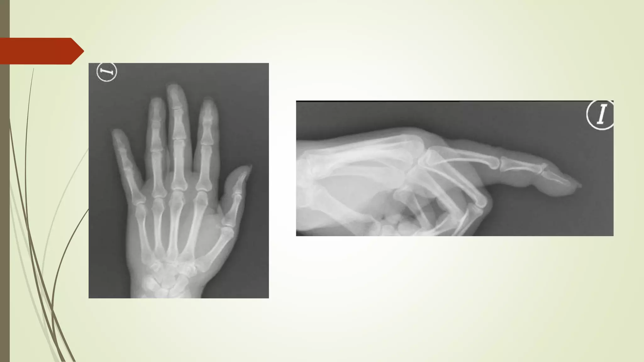 Fracturas falanges | PPTX