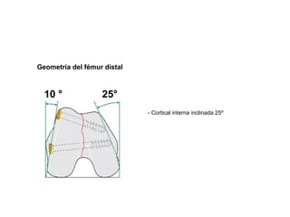 Geometría del fémur distal



  10 °             25°
                             - Cortical interna inclinada 25º
 
