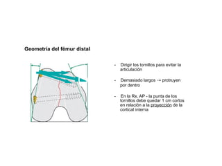 Geometría del fémur distal


                             -   Dirigir los tornillos para evitar la
                                 articulación

                             -   Demasiado largos → protruyen
                                 por dentro

                             -   En la Rx. AP - la punta de los
                                 tornillos debe quedar 1 cm cortos
                                 en relación a la proyección de la
                                 cortical interna
 