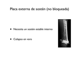 Placa externa de sostén (no bloqueada)




•   Necesita un sostén estable interno


•   Colapso en varo
 