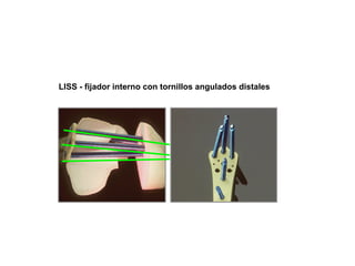 LISS - fijador interno con tornillos angulados distales
 