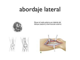 abordaje lateral
     Elevar el vasto externo por delante del
     tabique (septum) intermuscular externo
 