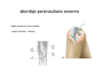abordaje pararotuliano externo


- Mejor exposición de los cóndilos

- Lesión muscular → fibrosis
 