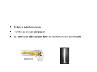 •   Reducir la superﬁcie articular

•   Tornillos de tracción compresión

•   Los tornillos se deben colocar donde no interﬁeran con el otro implante
 