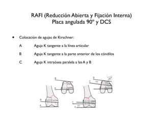 RAFI (Reducción Abierta y Fijación Interna)
                     Placa angulada 90º y DCS

•   Colocación de agujas de Kirschner:

    A
   
    Aguja K tangente a la línea articular

    B
   
    Aguja K tangente a la parte anterior de los cóndilos

    C
 
      Aguja K intraósea paralela a las A y B
 
