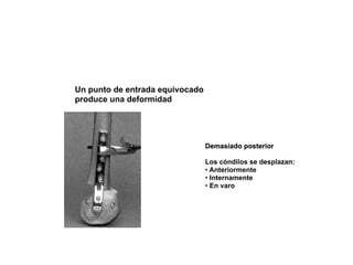 Un punto de entrada equivocado
produce una deformidad




                                 Demasiado posterior

                                 Los cóndilos se desplazan:
                                 • Anteriormente
                                 • Internamente
                                 • En varo
 