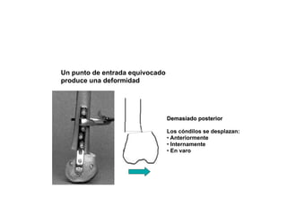 Un punto de entrada equivocado
produce una deformidad




                                 Demasiado posterior

                                 Los cóndilos se desplazan:
                                 • Anteriormente
                                 • Internamente
                                 • En varo
 