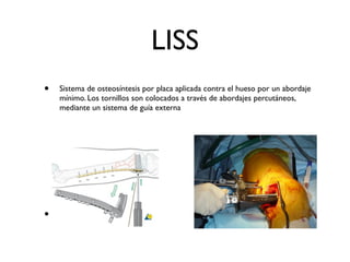 LISS
•   Sistema de osteosíntesis por placa aplicada contra el hueso por un abordaje
    mínimo. Los tornillos son colocados a través de abordajes percutáneos,
    mediante un sistema de guía externa




•
 