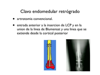 Clavo endomedular retrógrado
•   artrotomia convencional.

•   entrada anterior a la insercion de LCP y en la
    union de la linea de Blumensat y una linea que se
    extiende desde la cortical posterior
 