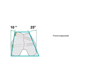 10 °   25°

             Forma trapezoidal
 