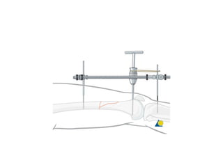 Fracturas femur distal 