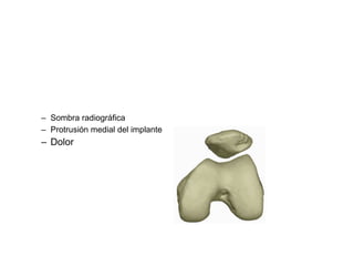 – Sombra radiográfica
– Protrusión medial del implante
– Dolor
 