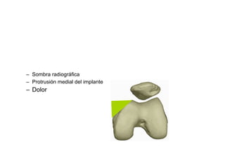 – Sombra radiográfica
– Protrusión medial del implante
– Dolor
 