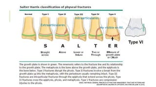 Extraarticulares
Intraarticulares
No visible en RX.
DAVIDJMATHISON.GENERALPRINCIPLESOFFRACTUREMANAGEMENT: FRACTUREPATTERNSAND
DESCRIPTIONINCHILDREN.IN:UPTODATE,WALTHAM,MA(JUNE18,2015).
 