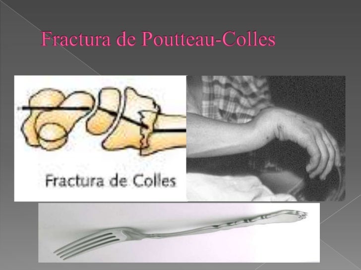 Fracturas frecuentes de miembros superiores e inferiores