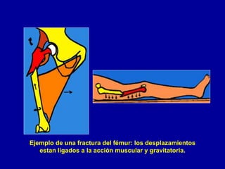 Ejemplo de una fractura del fémur: los desplazamientos
estan ligados a la acción muscular y gravitatoria.
 