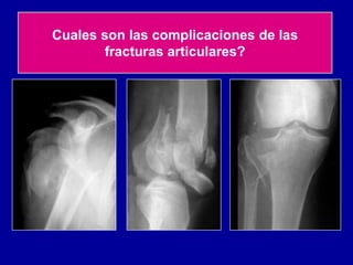 Cuales son las complicaciones de las
fracturas articulares?
 