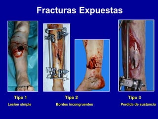 Fracturas Expuestas
Tipo 1 Tipo 2 Tipo 3
Lesion simple Bordes incongruentes Perdida de sustancia
 