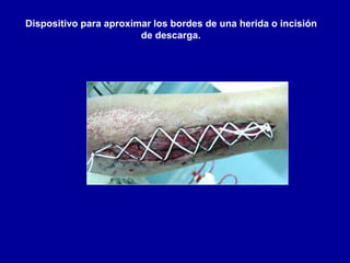 Dispositivo para aproximar los bordes de una herida o incisión
de descarga.
 