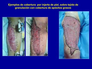 Ejemplos de cobertura por injerto de piel, sobre tejido de
granulación con cobertura de apósitos grasos
 