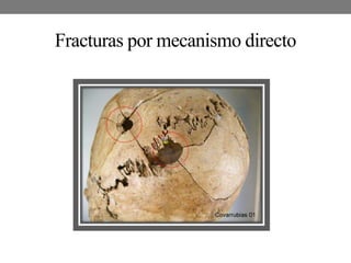 Fracturas por mecanismo directo
 