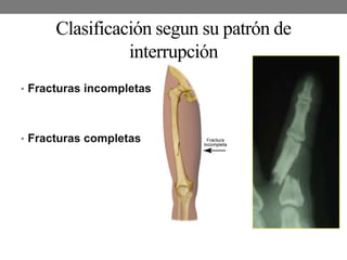 Clasificación segun su patrón de
interrupción
• Fracturas incompletas
• Fracturas completas
 