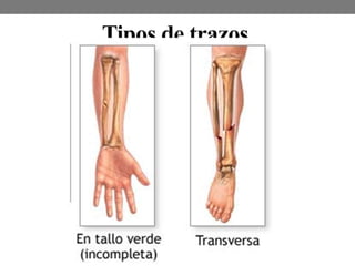 Tipos de trazos
 
