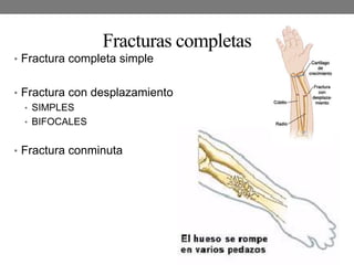 Fracturas completas
• Fractura completa simple
• Fractura con desplazamiento
• SIMPLES
• BIFOCALES
• Fractura conminuta
 