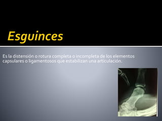 Es la distensión o rotura completa o incompleta de los elementos
capsulares o ligamentosos que estabilizan una articulación.
 