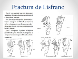 Fractura de Lisfranc
 