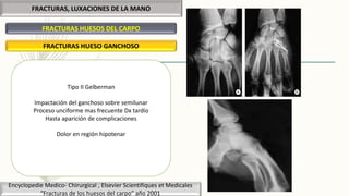 FRACTURAS, LUXACIONES DE LA MANO
FRACTURAS HUESOS DEL CARPO
Encyclopedie Medico- Chirurgical , Elsevier Scientifiques et Medicales
“Fracturas de los huesos del carpo” año 2001
FRACTURAS HUESO GANCHOSO
Tipo II Gelberman
Impactación del ganchoso sobre semilunar
Proceso unciforme mas frecuente Dx tardío
Hasta aparición de complicaciones
Dolor en región hipotenar
 