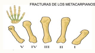 FRACTURAS DE LOS METACARPIANOS
 